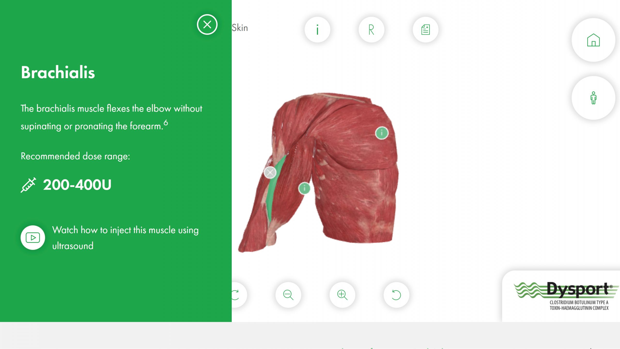 Dysport® Muscle Maps